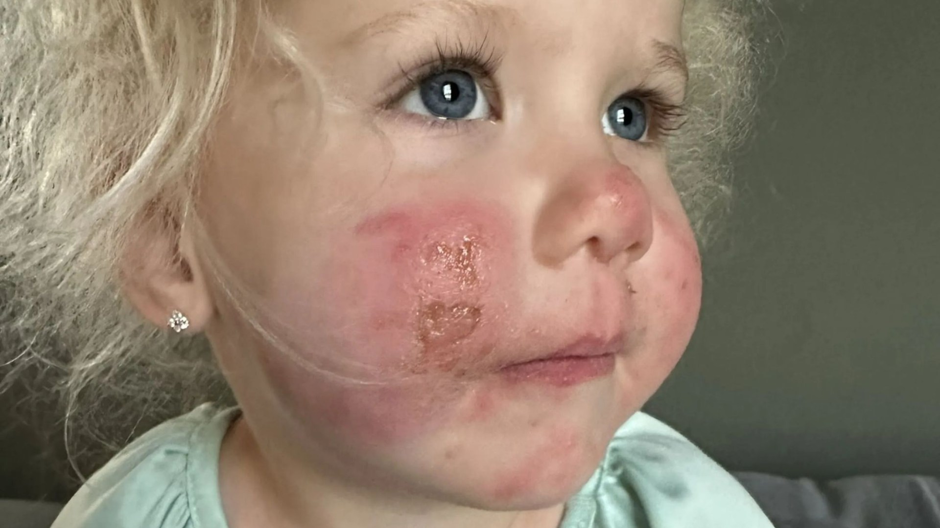 Mum’s warning after toddler’s face erupted in ‘red, angry blisters’ in garden