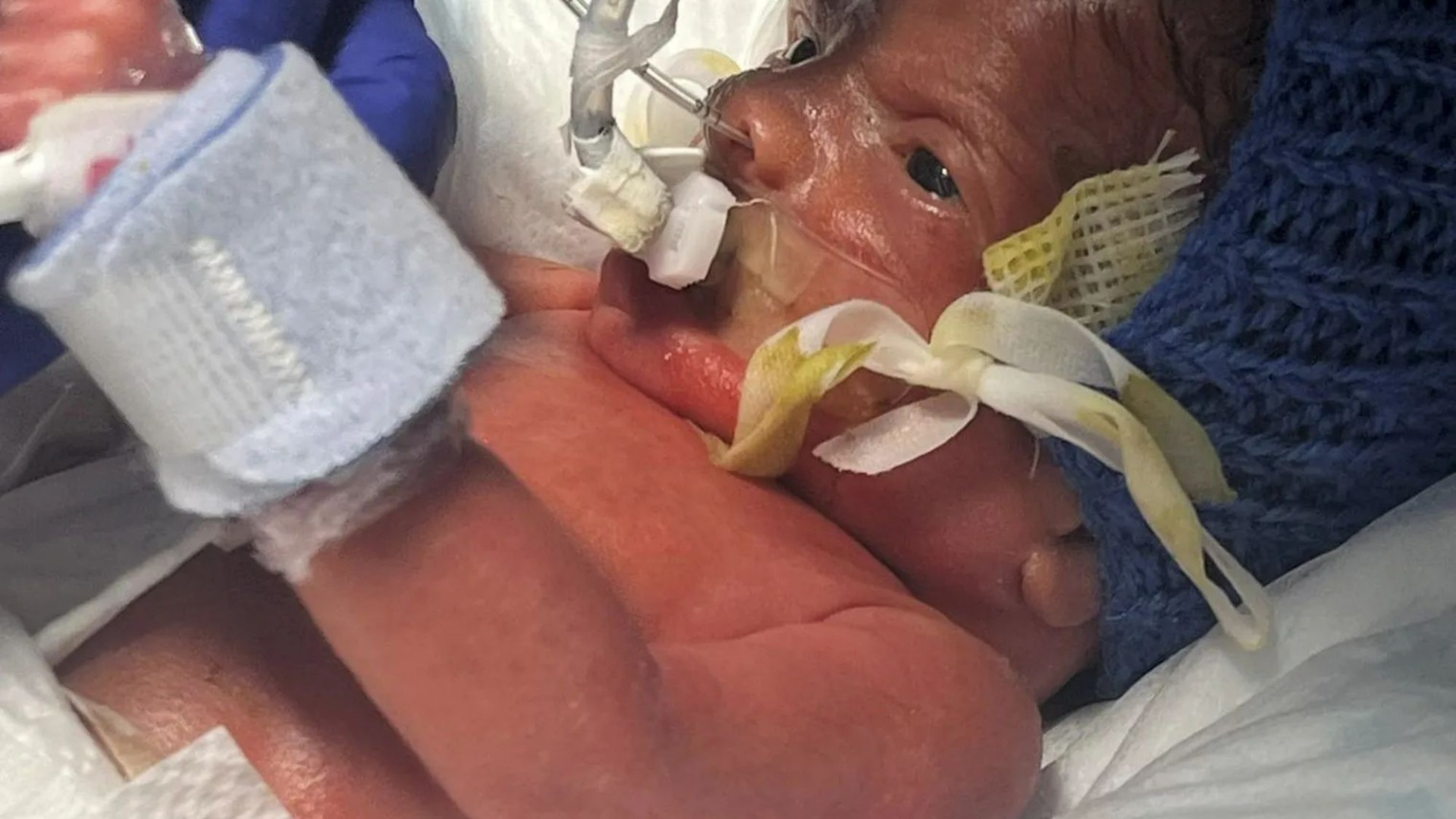 Parents’ heartbreak as baby born with skin so fragile they can’t hold him and doctors think he’ll die before Christmas